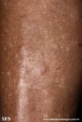 angioleiomyoma