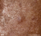 angioleiomyoma