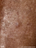 angioleiomyoma