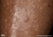 angioleiomyoma