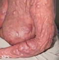 mycosis fungoides