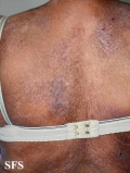 mycosis fungoides
