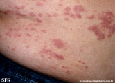 granuloma_annulare-interstitial_variant_of _granuloma_annulare