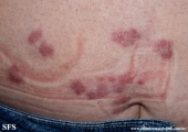 granuloma_annulare-interstitial_variant_of _granuloma_annulare