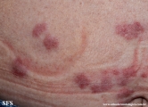 granuloma_annulare-interstitial_variant_of _granuloma_annulare