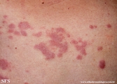 granuloma_annulare-interstitial_variant_of _granuloma_annulare