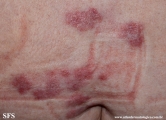 granuloma_annulare-interstitial_variant_of _granuloma_annulare