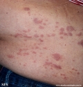 granuloma_annulare-interstitial_variant_of _granuloma_annulare