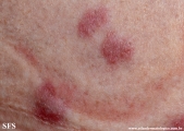 granuloma_annulare-interstitial_variant_of _granuloma_annulare