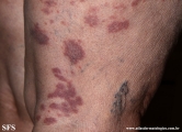 granuloma_annulare-interstitial_variant_of _granuloma_annulare