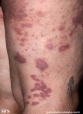 granuloma_annulare-interstitial_variant_of _granuloma_annulare