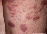 granuloma_annulare-interstitial_variant_of _granuloma_annulare