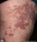 granuloma_annulare-interstitial_variant_of _granuloma_annulare