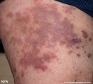 granuloma_annulare-interstitial_variant_of _granuloma_annulare