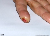carpal syndrome -painful ulcer on finge