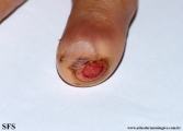carpal syndrome -painful ulcer on finge