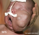 lymphatic malformations
