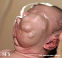lymphatic malformations