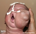 lymphatic malformations