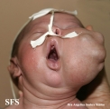 lymphatic malformations