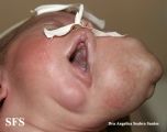 lymphatic malformations