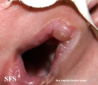 lymphatic malformations