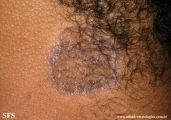 lichen planus annular