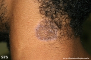 lichen planus annular