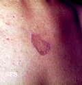 lichen planus annular