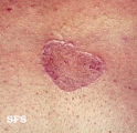 lichen planus annular