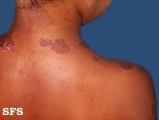 lichen planus annular