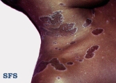 lichen planus annular