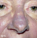 hyperpigmentation due to amiodarone