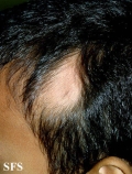 alopecia triangularis congenita