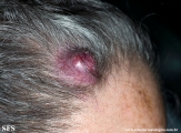 metastatic-renal cell carcinoma