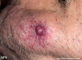 metastatic-renal cell carcinoma