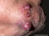 metastatic-renal cell carcinoma