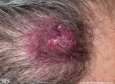 metastatic-renal cell carcinoma