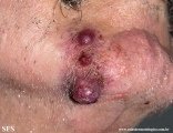 metastatic-renal cell carcinoma