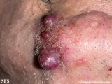 metastatic-renal cell carcinoma