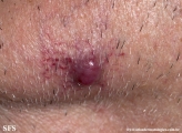 metastatic-renal cell carcinoma