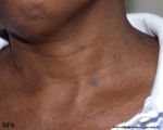 syphilis secondary