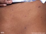 syphilis secondary