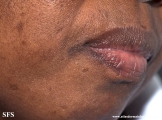 syphilis secondary