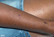 syphilis secondary