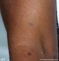 syphilis secondary