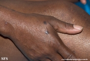 syphilis secondary