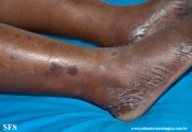 syphilis secondary