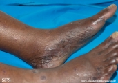 syphilis secondary