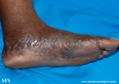 syphilis secondary
